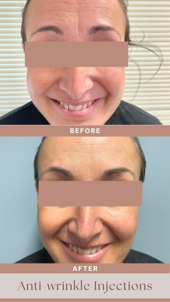 Before and After Anti-Wrinkle Injections